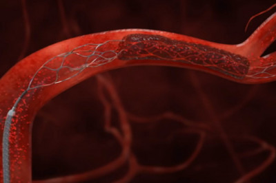 Mechanical Thrombectomy Devices  Market Size Global Industry Demand, Share, Key Findings, Key Trends, Regional Analysis, Key Players Profiles, Future Prospects and Forecasts to 2027