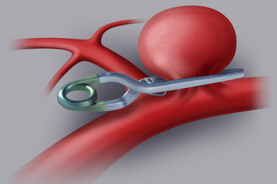 Magnetic Resonance Imaging in Intracranial Aneurysm Clips Patients