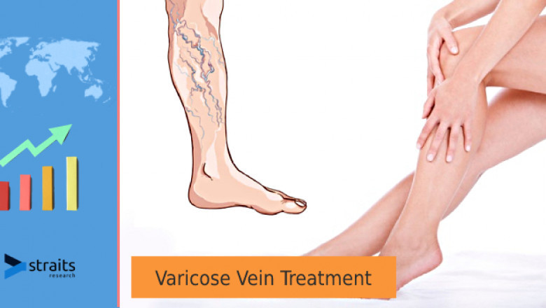 Varicose Vein Treatment Market Analysis; Future Scope and Price Analysis By 2027