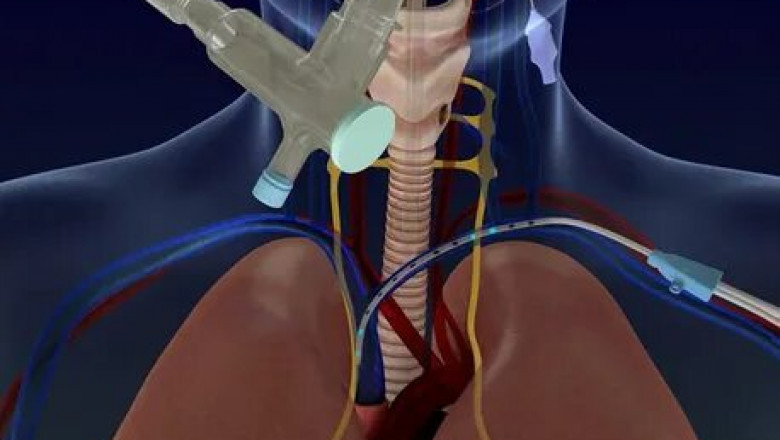 Diaphragm Pacing Therapy System Market worldwide market size and share 2022-2028| Research Informatic