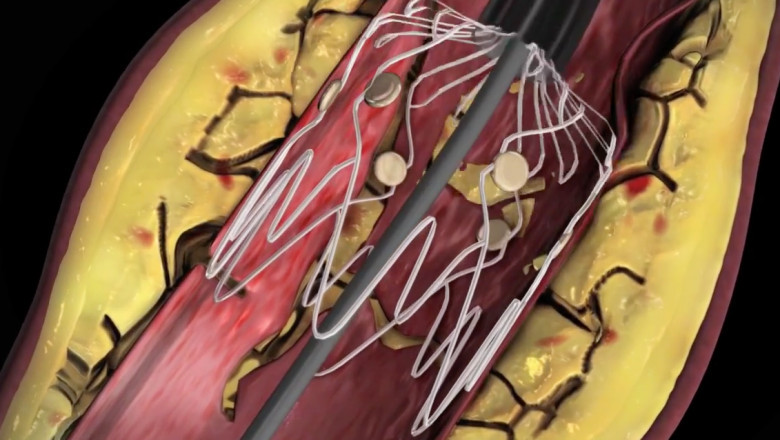 Peripheral Vascular Devices Market Size, $17,679.72 Million by 2028 Lead by Peripheral Vascular Stents, 6.5% CAGR