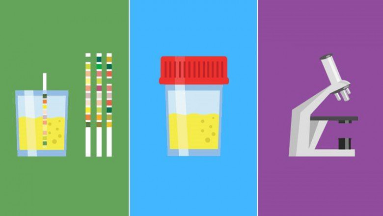 Urinalysis Market Share by 2025: Global and Regional Analysis and Products made possible