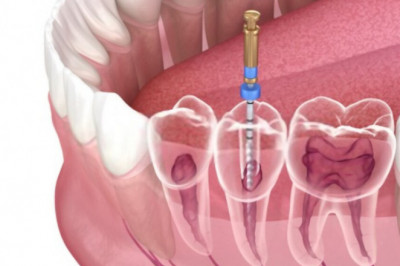 5 Signs Of Infection After Root Canal Treatment