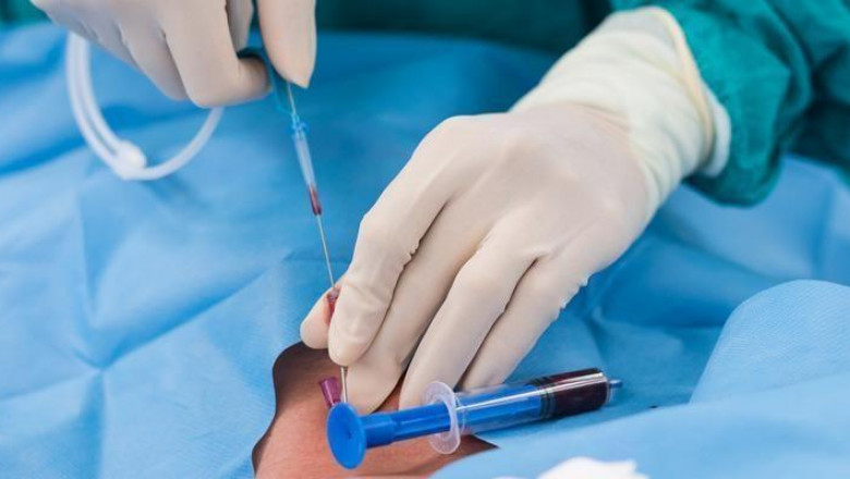 What Are Central Venous Catheters?
