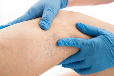 Global Varicose Veins Treatment Market Restraints