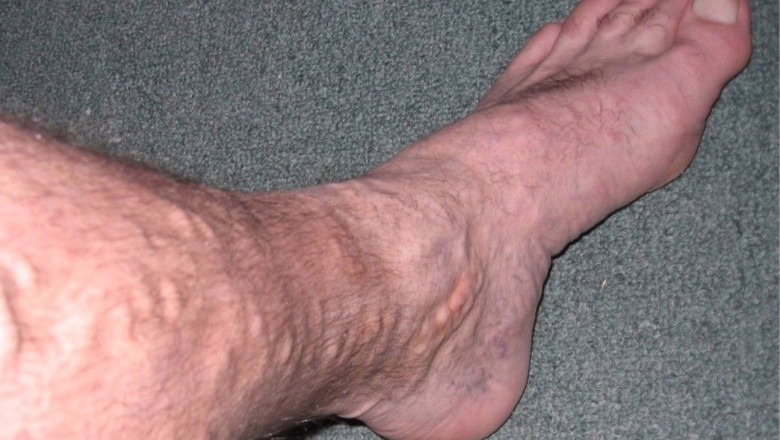 How Effective Is Laser Treatment For Varicose Veins?