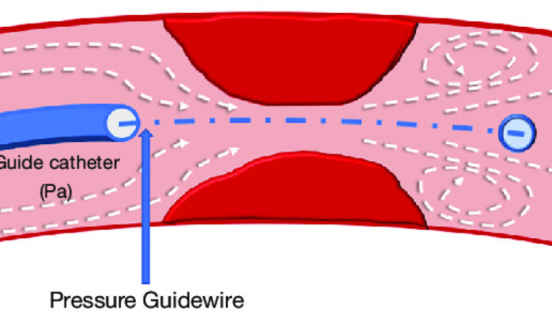 Fractional Flow Reserve Market | Analysis, Recent Trends and Regional Growth Forecast by 2028