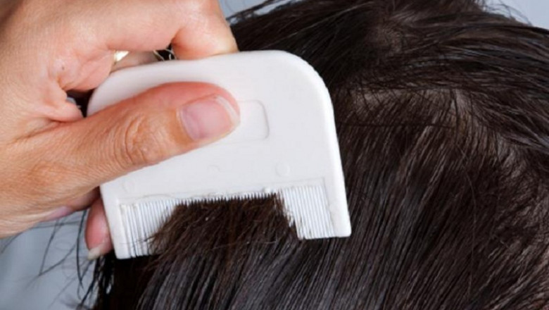 Head Lice Treatment Market Size, Development, Share and Forecast to 2028 Including Covid19 Impact | Eli Lilly and Company, Galderma Laboratories, L.P., Edenbridge Pharmaceuticals, LLC