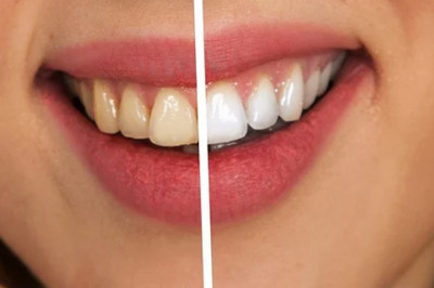 Comparison of Laser Teeth Whitening and LED cold light bleaching