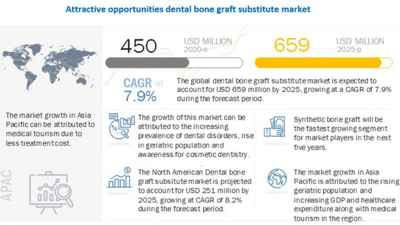 Dental Bone Graft Substitute Market Worth USD 659 million by 2025 : Continuous Product Commercialization
