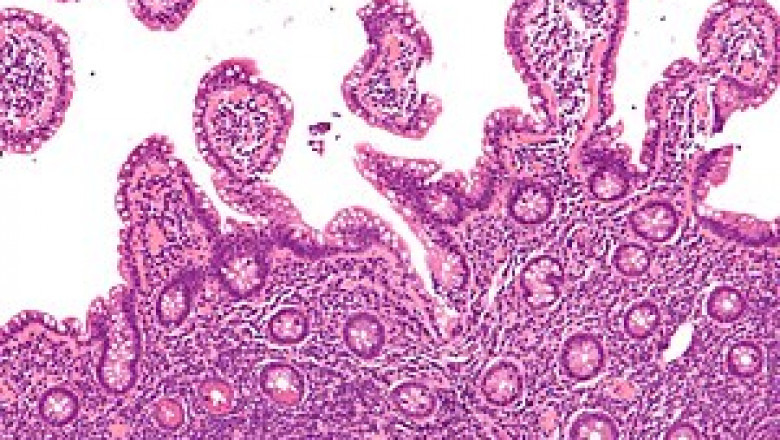 What is the prognosis for Mantle Cell Lymphoma Treatment?