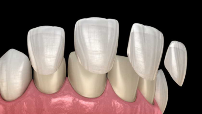 Dental Veneers and Dental Bonding :All You Need To Know