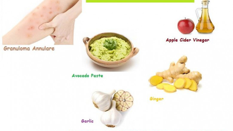 Natural Remedies for Granuloma Annulare Inflammatory Skin Rash Issues