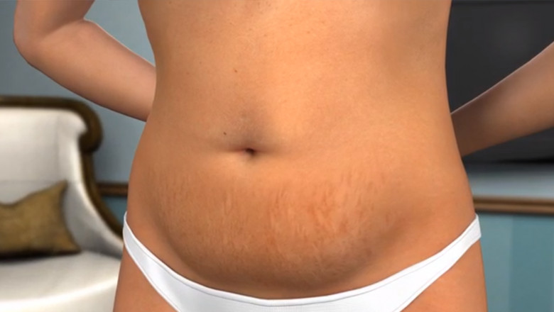 Why Is Mini Tummy Tuck Procedure Recommended For Reducing Belly Fat?