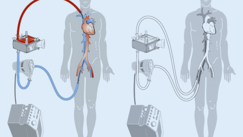 Extracorporeal Membrane Oxygenation Machine Market Competitive landscape, Key company profile analysis, Opportunities 2028