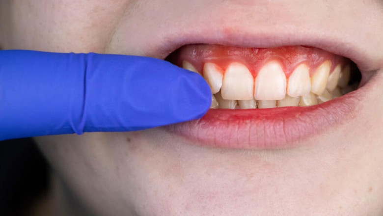 Is Gingivectomy Permanent?