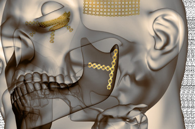 Craniomaxillofacial Implants Market Analysis, Size, Share, Growth, Trends, and Forecast 2019 - 2027