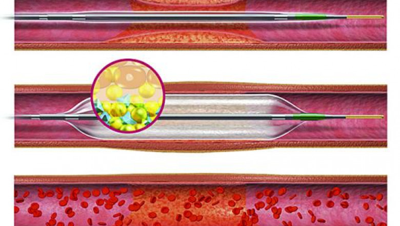 Drug Eluting Stents Market Size, Regional Outlook, Price Trends, Competitive Market Share & Forecast, 2019 - 2027