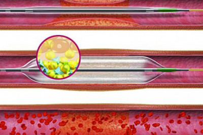 Drug Eluting Stents Market Size, Regional Outlook, Price Trends, Competitive Market Share & Forecast, 2019 - 2027