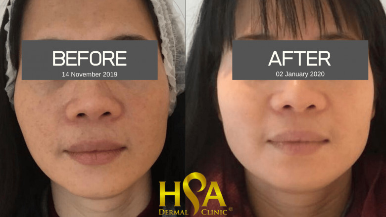 Expert Lip Filler and Chemical Peel in London