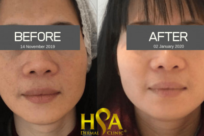 Expert Lip Filler and Chemical Peel in London