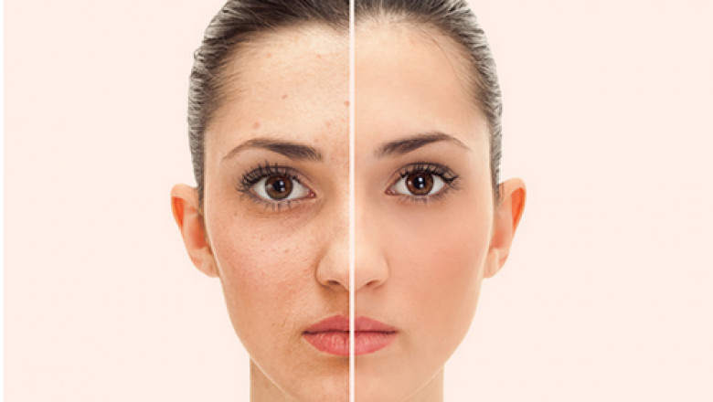 Facelift Complications and Safety with Dr.Corey Torgerson