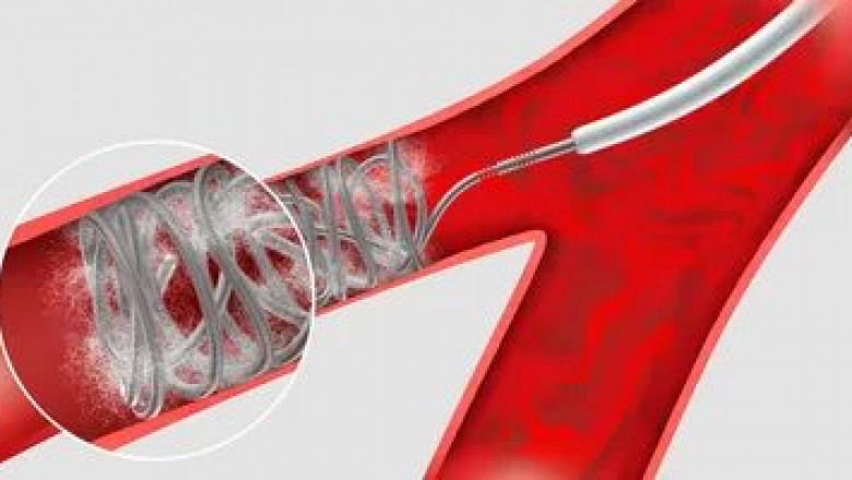 In uterine artery Embolization Particle , what particles are used?