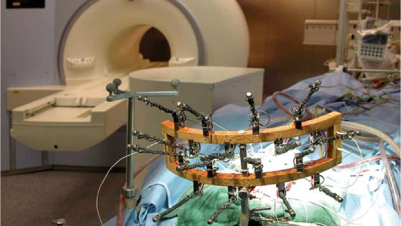Analyses the integrity of the brain during surgery by using Intraoperative Monitoring Electrodes electrodes