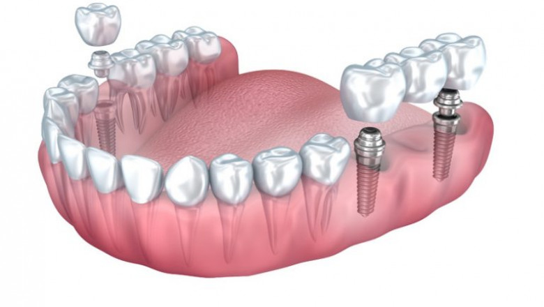 Why Invisible Braces Are Right Choice ?