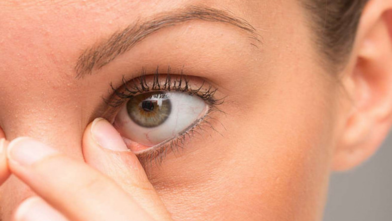 Blepharitis Treatment; Patients Need to Maintain A Good Hygiene Regimen to Prevent Recurrences