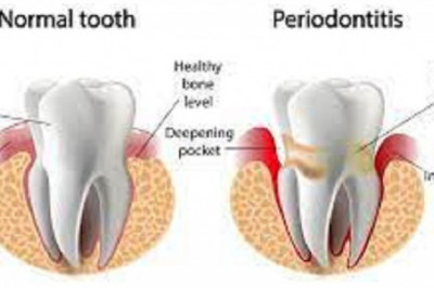 Dental Periodontics Market Size, Share, Forecast, & Industry Analysis 2028