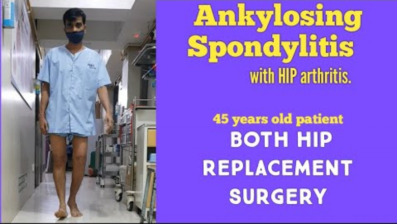 Mr.Anil Sharing His Experience Ankylosing Spondylitis in HIP Replacement surgery Mulund Mumbai India