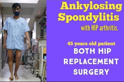 Mr.Anil Sharing His Experience Ankylosing Spondylitis in HIP Replacement surgery Mulund Mumbai India