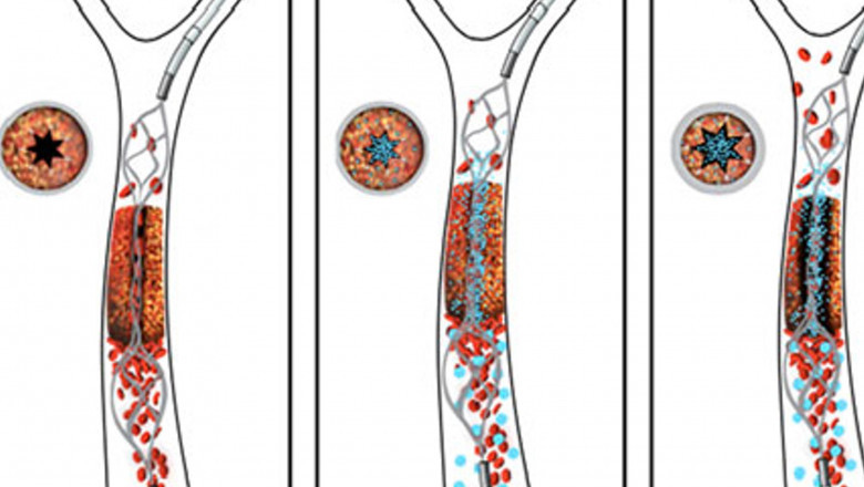 Vasculitis Treatment Market - Global Industry Insights, Trends, Outlook, and Opportunity Analysis, 2018-2026