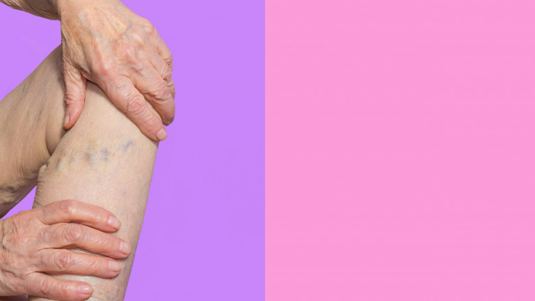 What More Do You Need To Know About Vein Clinics?