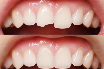 5 Consequences of Tooth Chipped 