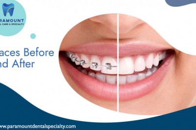 Braces Before And After