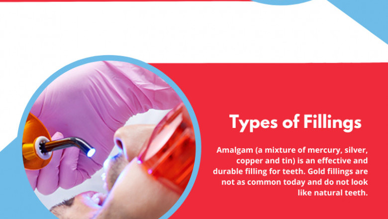 How Long do Fillings Take for Tooth Cavities? | Top Emergency Dentists