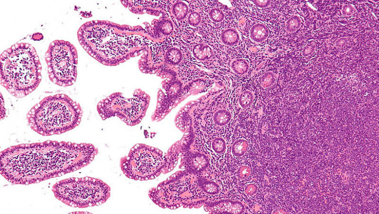Markets for mantle cell lymphoma treatments are segmented based on the treatments offered