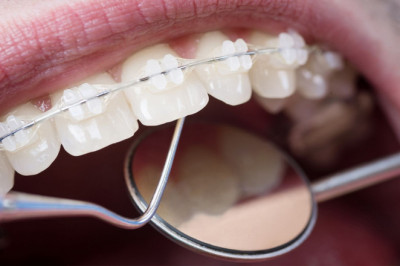 Orthodontic Supplies Market Size & Share Analysis with Industry Overview, CAGR, Trends, Scope, Demand, Opportunity