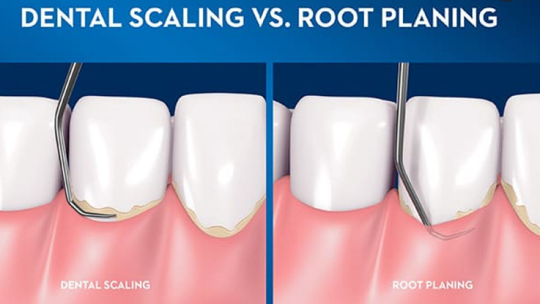 Why a Dental Deep Cleaning Might Become Necessary