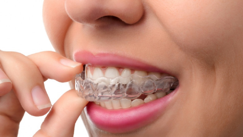 How Do I Know If Need Veneers?
