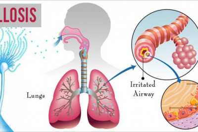 Aspergillosis Treatment Market Dynamics