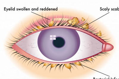 Blepharitis Treatment Market Drivers