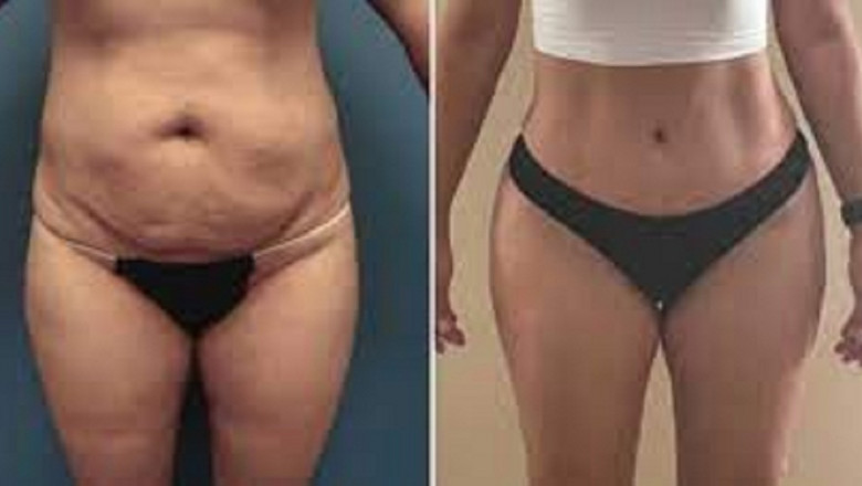 What Do You Need To Know About Tummy Tuck Surgery?