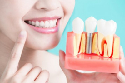 All about dental implants