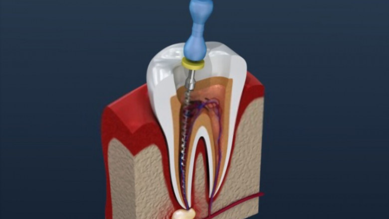 All About Root Canals treatment
