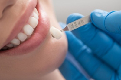 Everything You Need to Know About Dental Crowns.
