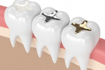 What are dental fillings?