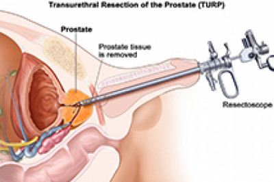 TURP surgery in India